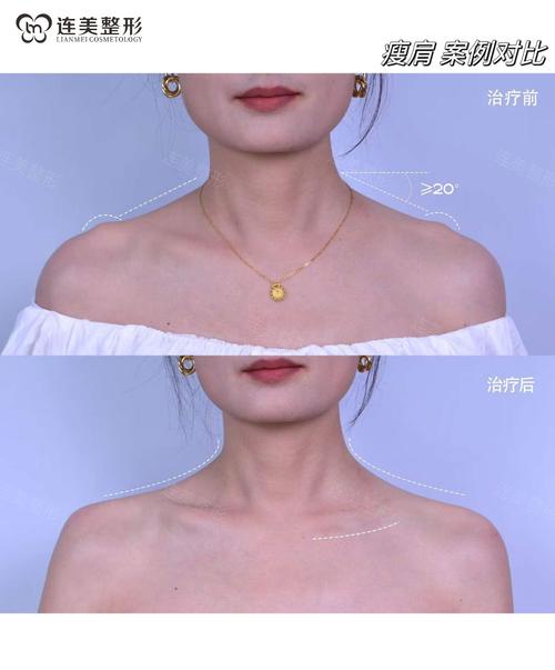 新奥精准数据免费开放和女子打瘦肩针险丧命与打瘦肩针的部位图解